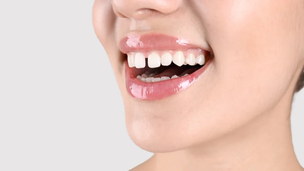 Gap Between Teeth (Diastema) — Causes and Solutions