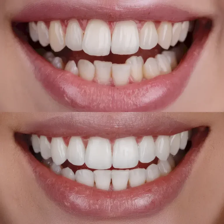 До и после лечения