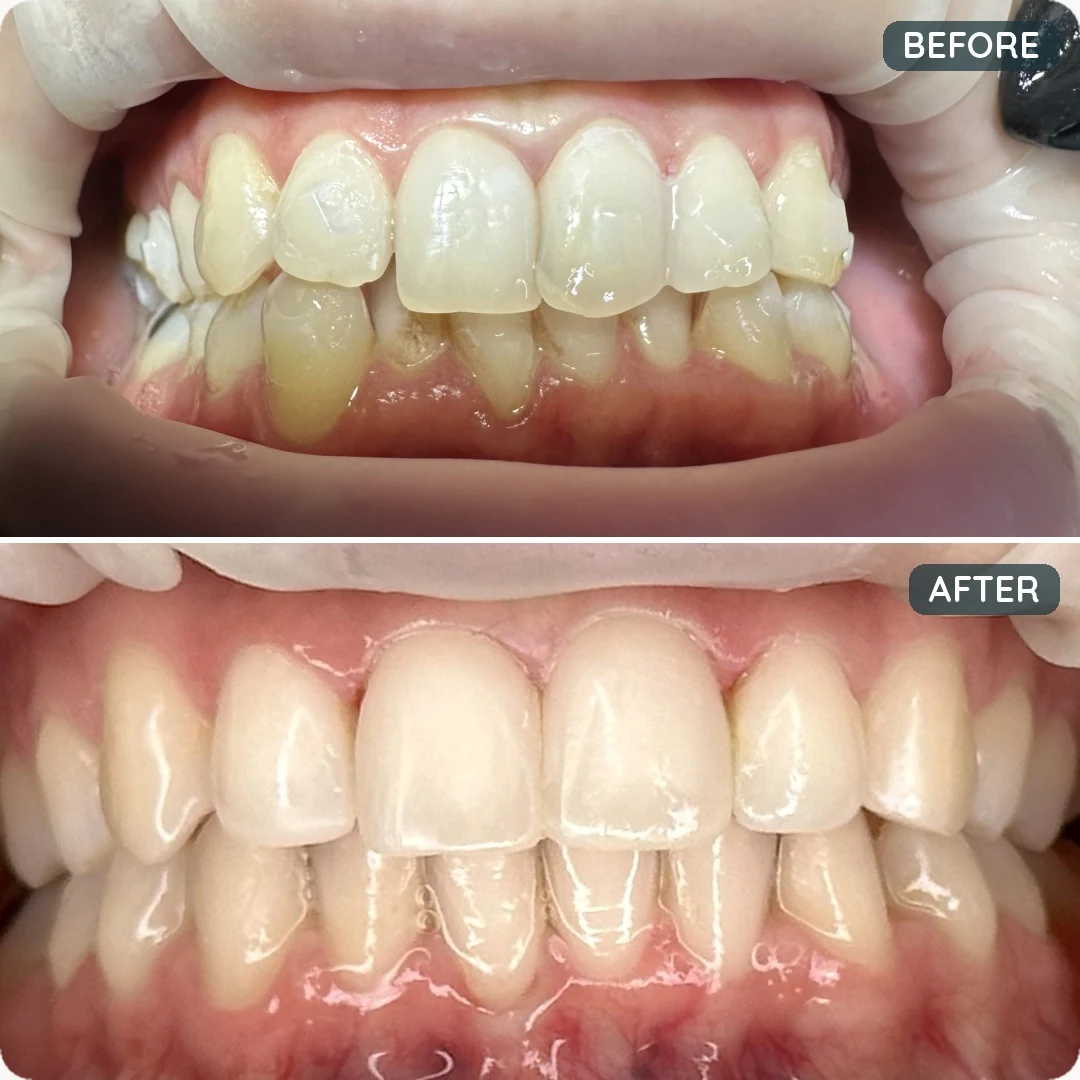 Before and after treatment — patient 1