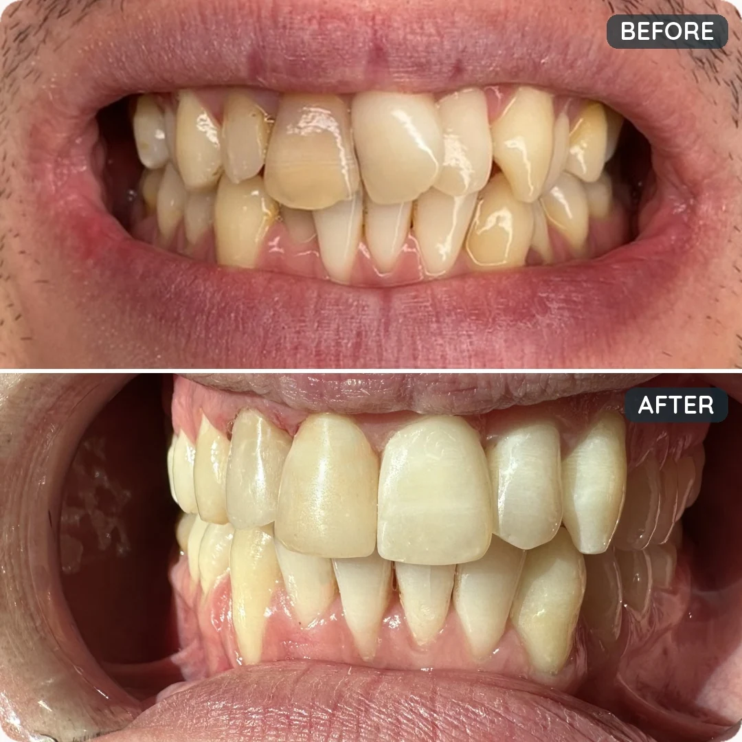 Before and after treatment — patient 2