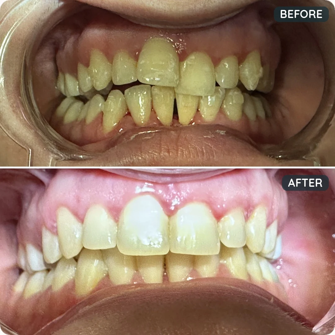Before and after treatment — patient 4