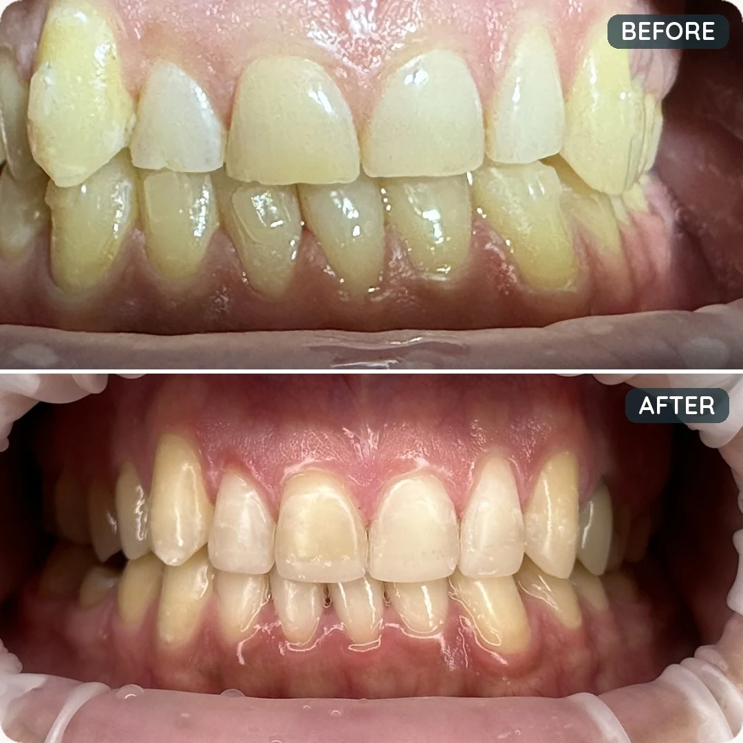 Before and after treatment — patient 6