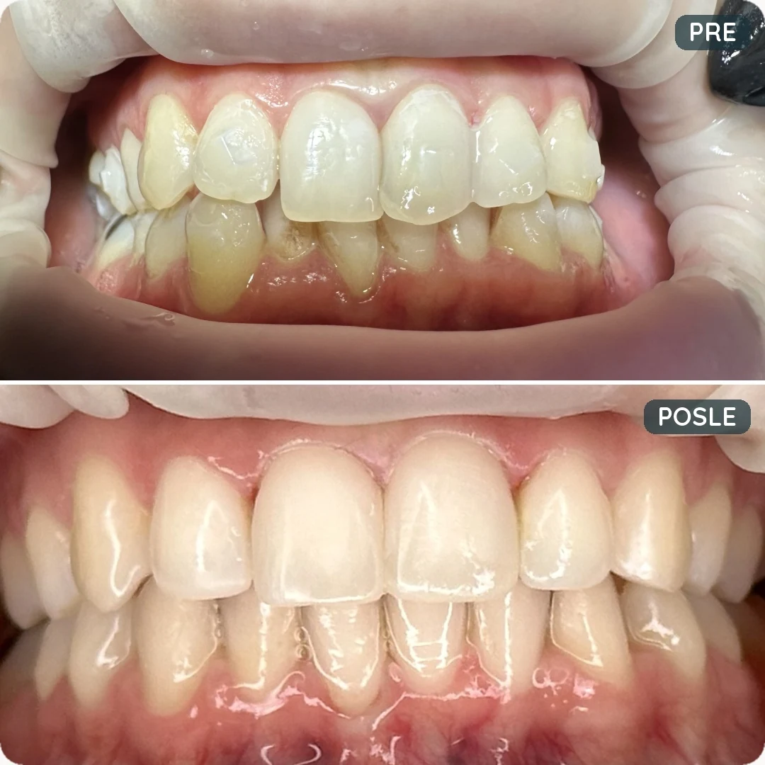 Pre i posle tretmana — pacijent 1