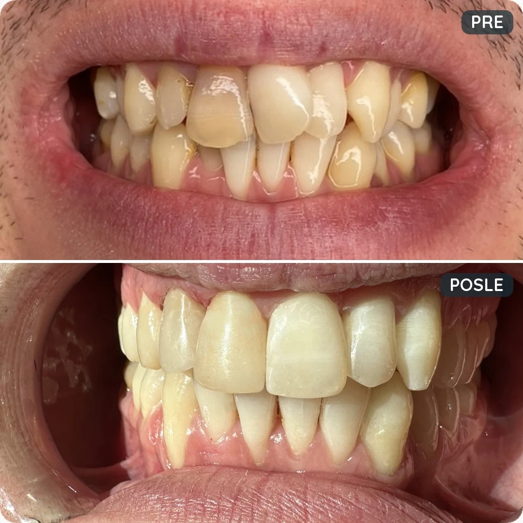 Pre i posle tretmana — pacijent 2