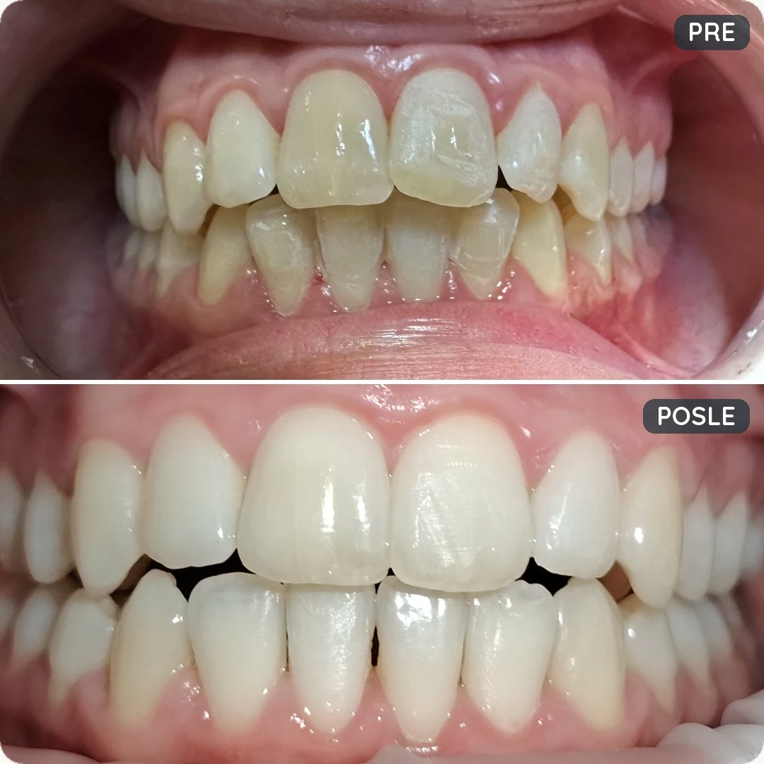 Stvarna fotografija pre i posle tretmana alignerima u SmileStore
