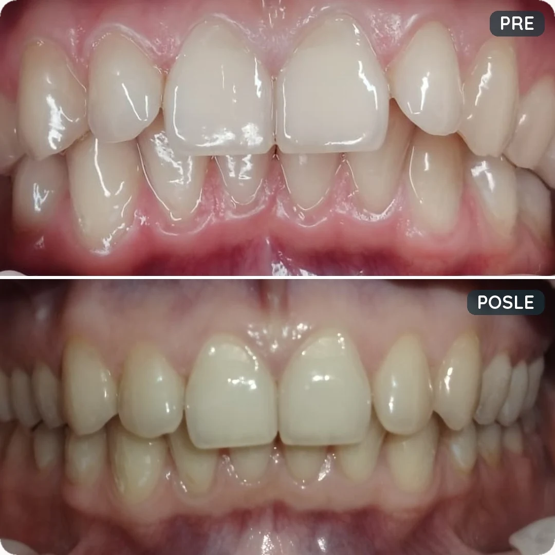 Stvarna fotografija pre i posle pacijenta SmileStore Beograd