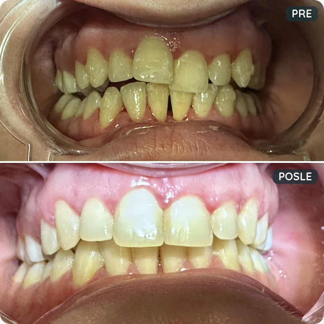 Pre i posle tretmana — pacijent 4