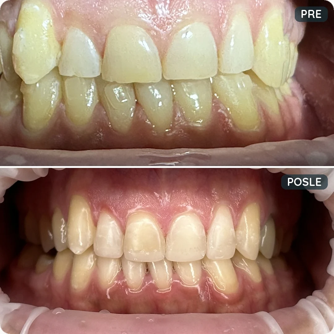 Pre i posle tretmana — pacijent 6