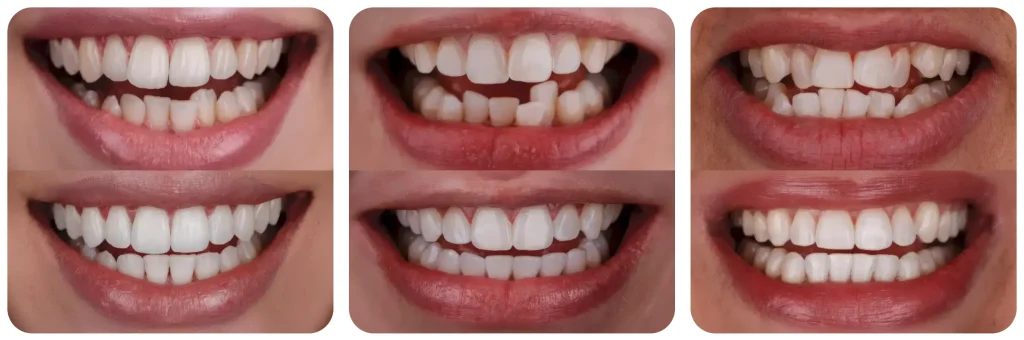 Sertifikati sa kursa Advanced Clear Aligners u Madridu