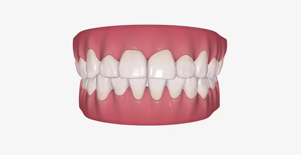 Ravan osmeh sa korigovanom rotacijom očnjaka posle 15 faza alignera