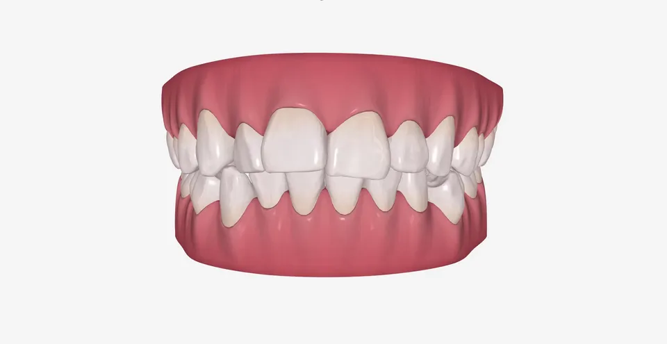 Rotirani gornji očnjaci i neravna linija osmeha pre ortodontske korekcije nevidljivim aparatićem