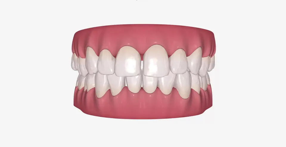 Zatvoreni razmaci i poravnati prednji zubi posle 17 faza sa providnim folijama