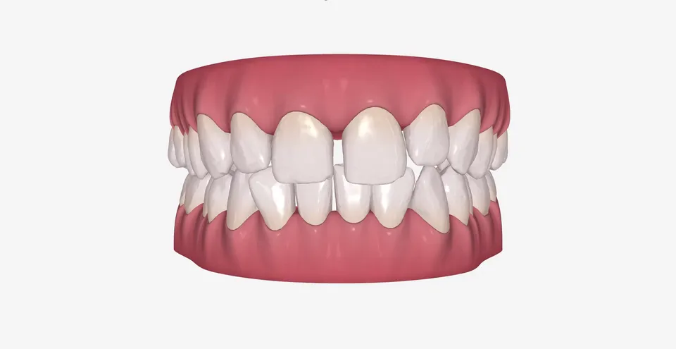 Dijastema i razmaci između gornjih prednjih zuba pre tretmana prozirnim aparatićem za zube