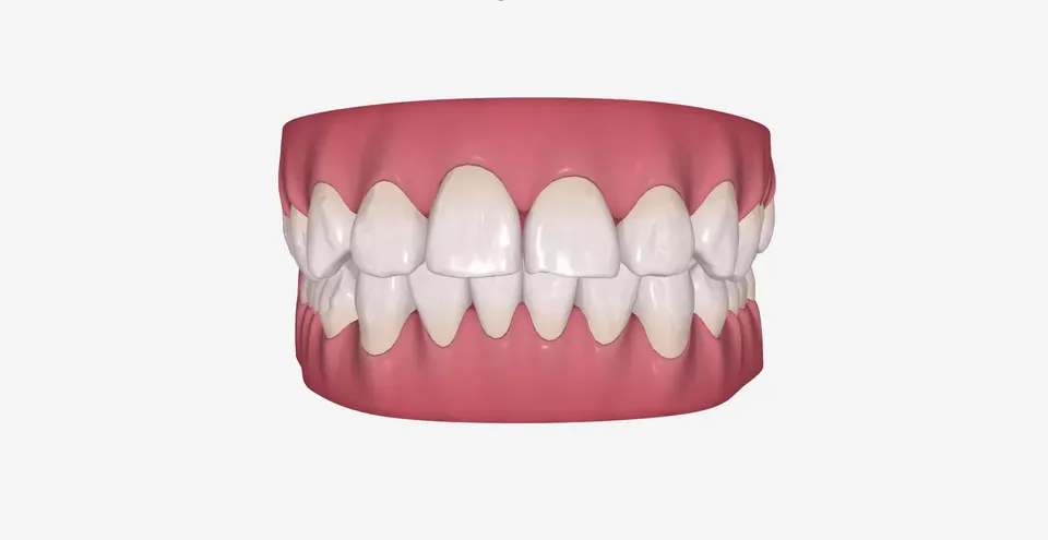 Obe vilice potpuno poravnate posle sveobuhvatnog tretmana od 20 faza nevidljivim folijama