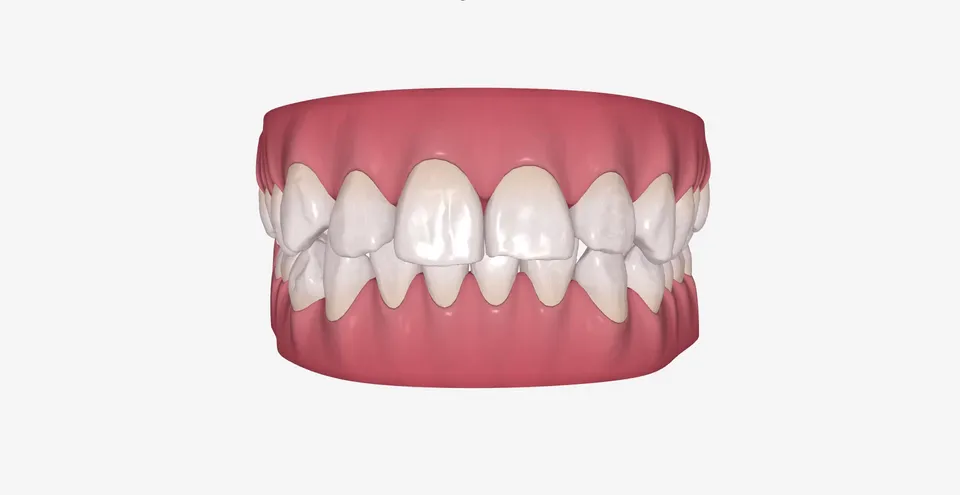 Složena malokluzija sa teskobom u obe vilice pre kompletne korekcije alignerima