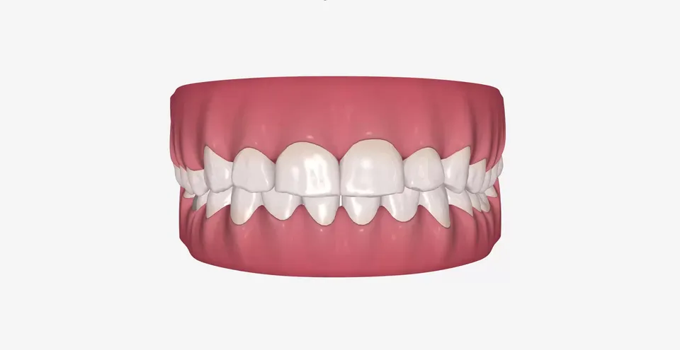 Ravnomerno poređani donji zubi posle 17 faza tretmana alignerima u SmileStore Beograd