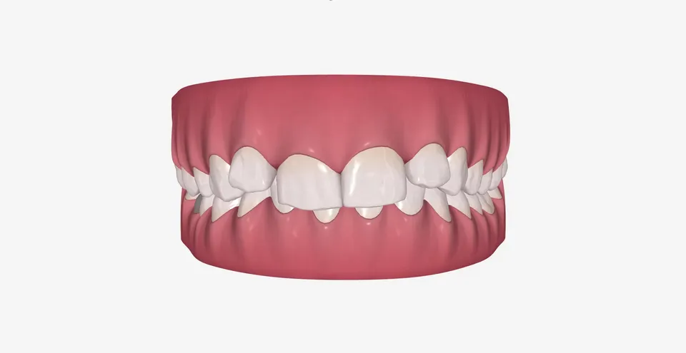 Preklapanje donjih sekutića i teskoba pre terapije providnim folijama za ispravljanje zuba